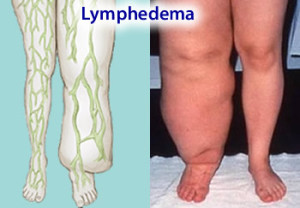 lymphedema